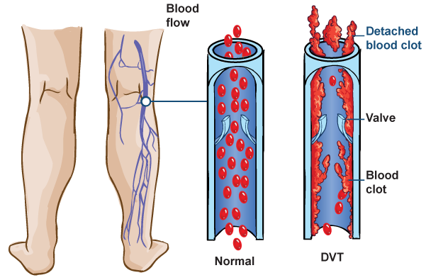 Protect yourself from Deep vein Thrombosis